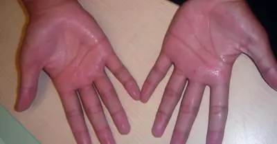 sudoracion-manos