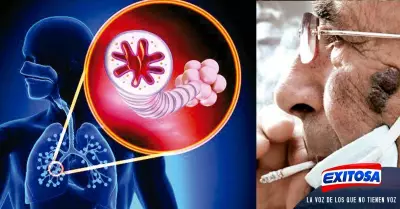 Bronquiectasia-Medidas-de-prevencin-para-evitar-la-infeccin-pulmonar