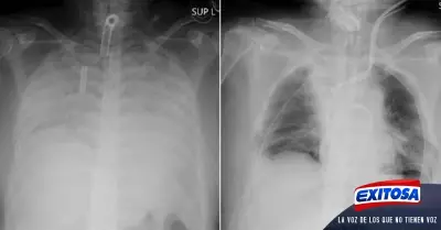 transplante-pulmon-covid