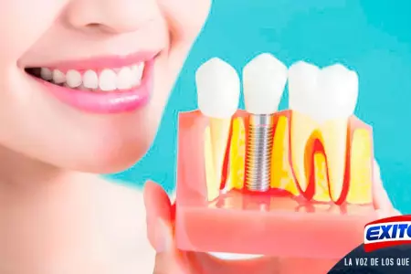 implantes-dentales-Exitosa