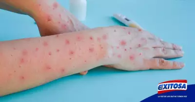 viruela-del-mono-vacuna-minsa-julio-exitosa