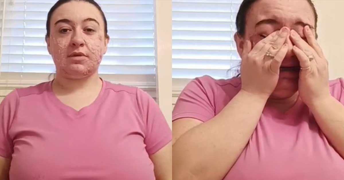 A young man shares videos to speak out against bullying for his condition called hidradenitis suppurativa