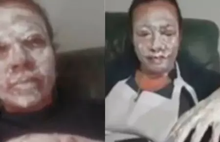 Ambulante termin con el rostro lleno de quemaduras tras intentar ser retirada d