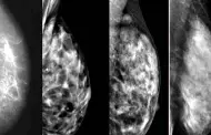 Podr ser esto posible?: Inteligencia Artificial podra detectar el cncer de mama 4 aos antes de formarse