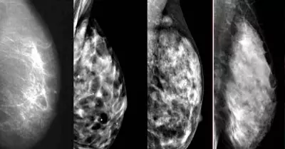 Inteligencia Artificial podra detectar el cncer de mama 4 aos antes de formar