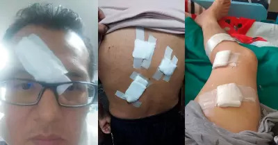 Delincuentes venezolanos atacan a poblador y lo dejan grave en hospital