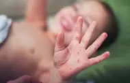 Surco: Ministerio de Salud informa que se report caso de sarampin en beb de 10 meses