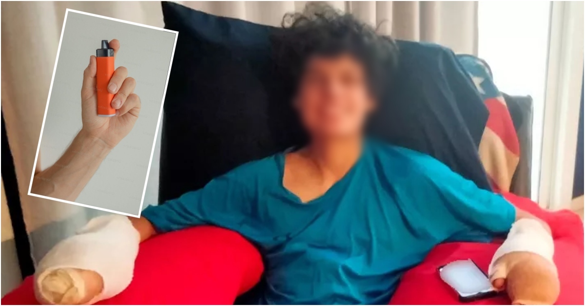 ¡Terrible! Adolescente de 15 años sufre amputación de su dedo tras explosión de vape en su cara