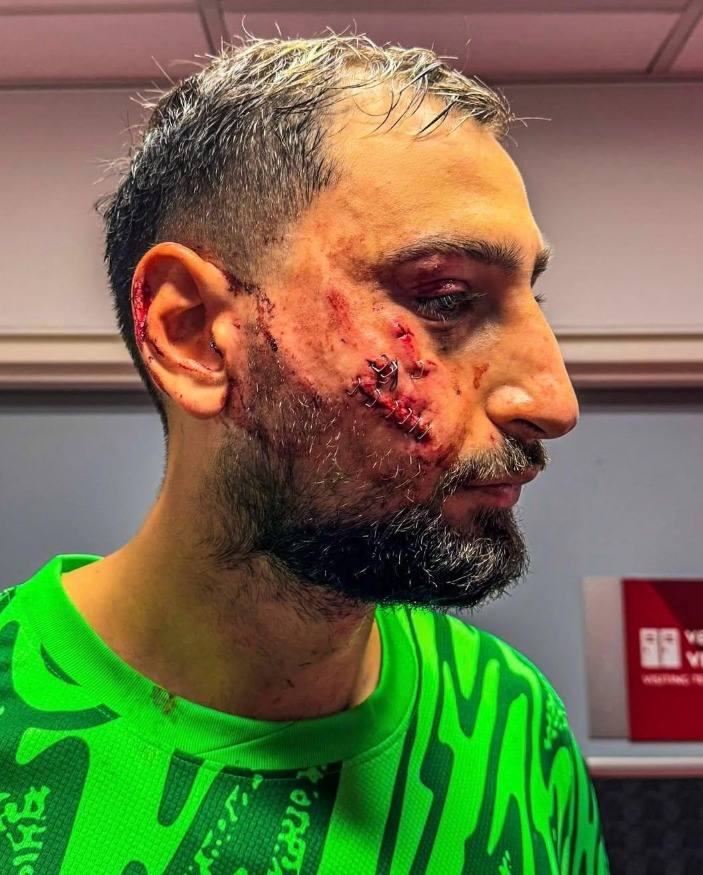 As qued el rostro de Gianluigi Donnarumma tras brutal golpe recibido.