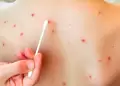 Minsa emite alerta epidemiologa: Se confirm un caso importado de sarampin en un nio de 11 aos
