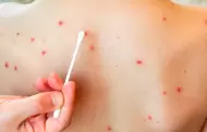 Minsa emite alerta epidemiologa: Se confirm un caso importado de sarampin en un nio de 11 aos