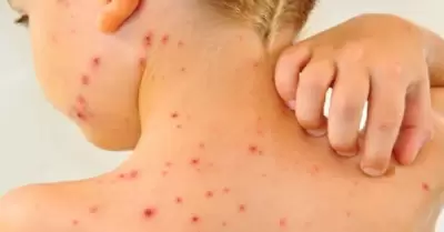 Segunda alerta epidemiológica por riesgo de sarampión desde Bolivia.