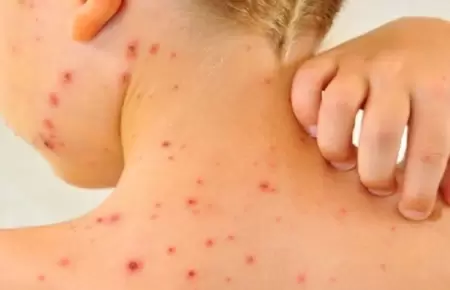 Segunda alerta epidemiolgica por riesgo de sarampin desde Bolivia.