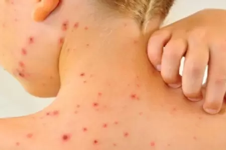 Segunda alerta epidemiolgica por riesgo de sarampin desde Bolivia.