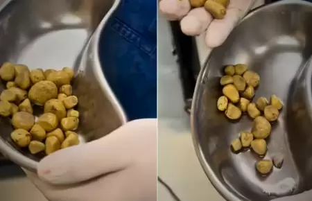 Piedras en el rin