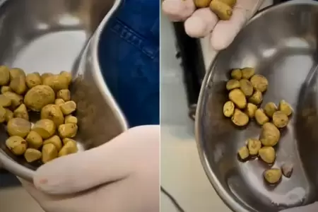 Piedras en el rin