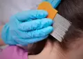 Piojos en temporada escolar: Cmo detectarlos y qu tratamientos s funcionan?