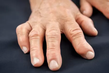 Artritis reumatoide sera agravada por el envejecimiento inmunolgico.