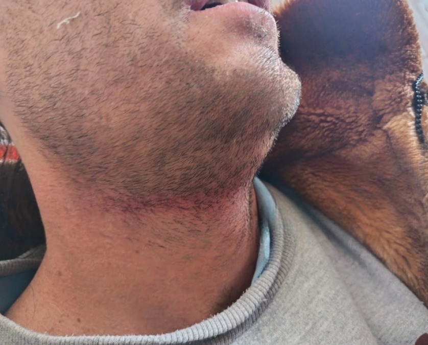 Así quedó el cuello de Joran van der Sloot tras intento de suicidio.