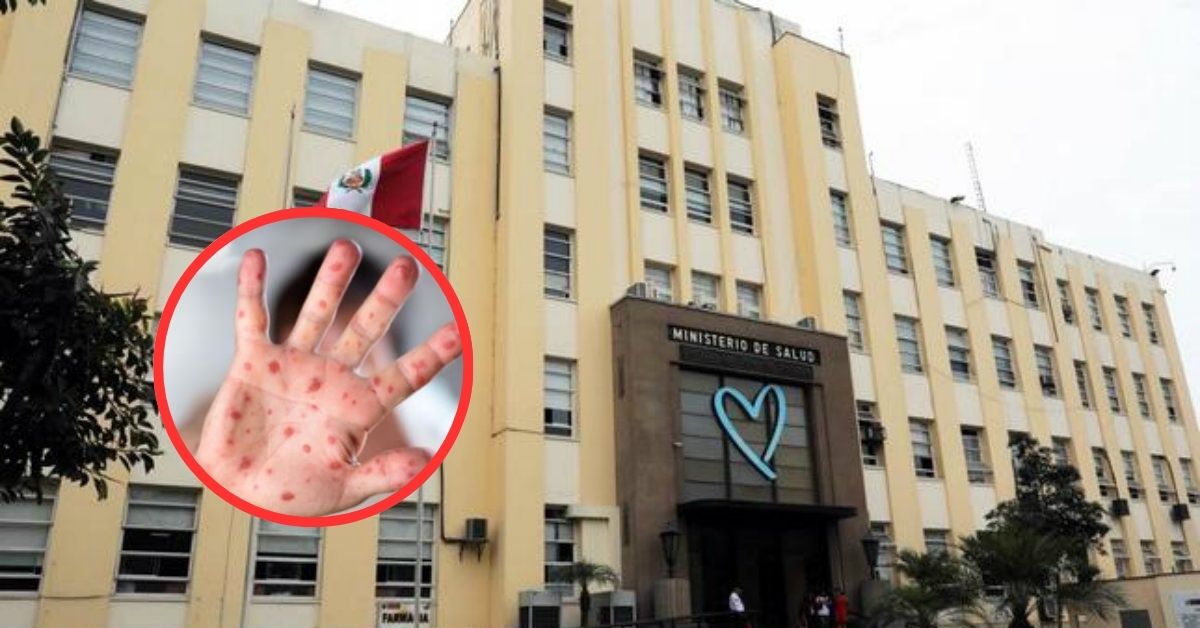Minsa declara emergencia sanitaria por brote de sarampión en Lima Metropolitana, Callao y otras 12 regiones