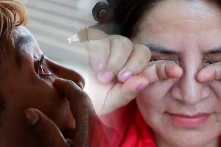 Alertan aumento de infecci�n por conjuntivitis en verano