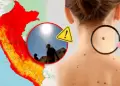 Alerta en verano: �En qu� regiones hay mayor riesgo de sufrir c�ncer de piel por radiaci�n UV extrema?