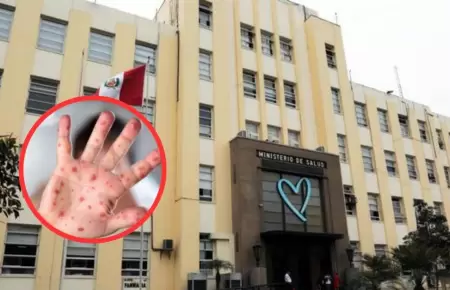 Minsa emite alerta epidemiol�gica ante posible importaci�n y contagio de sarampi