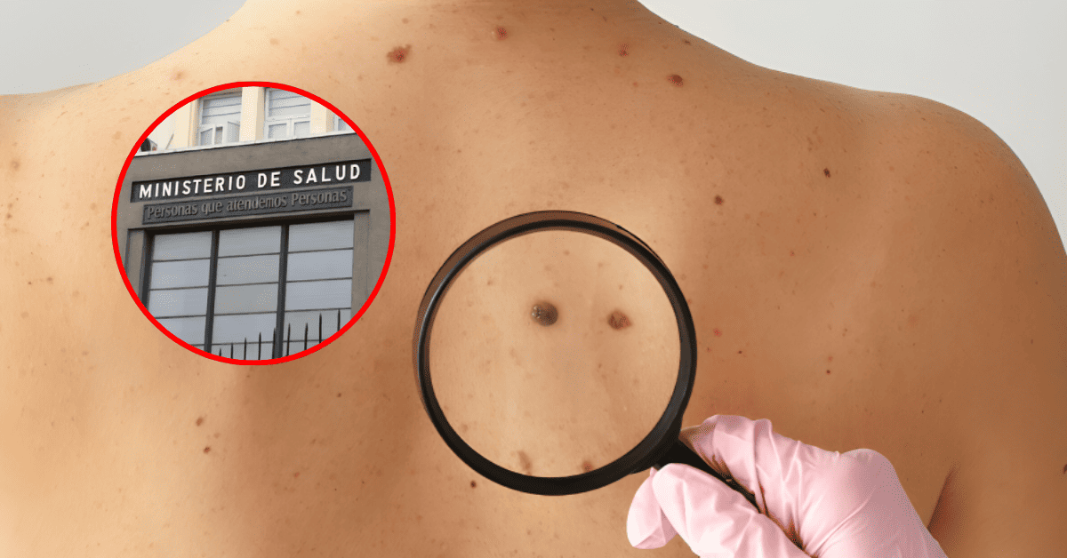 Minsa alerta sobre lunares sospechosos y cáncer de piel: Conoce el 'método ABCDE' para identificar aquellos que son malignos