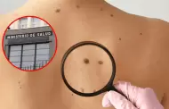 Minsa alerta sobre lunares sospechosos y c�ncer de piel: Conoce el 'm�todo ABCDE' para identificar aquellos que son malignos