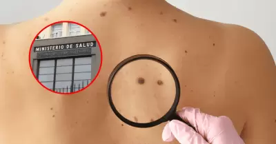 Minsa alerta sobre lunares sospechosos y c�ncer de piel