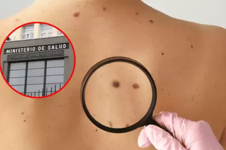 Minsa alerta sobre lunares sospechosos y c�ncer de piel