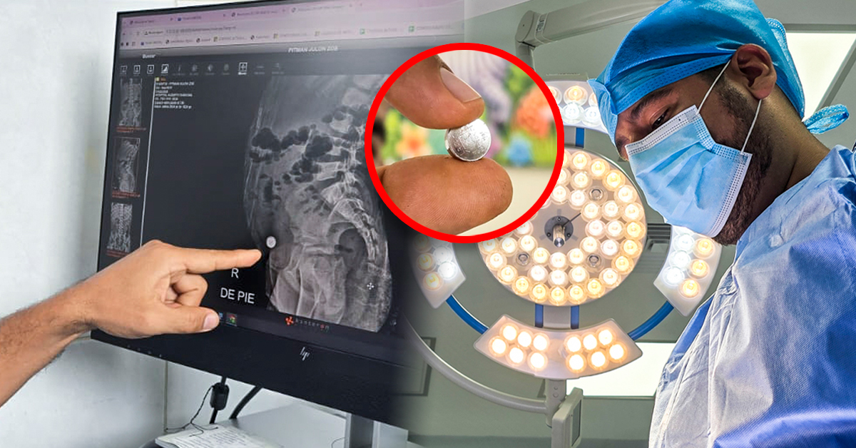 Niña sobrevive a riesgosa cirugía tras ingerir accidentalmente una pila de reloj y perder parte de su intestino