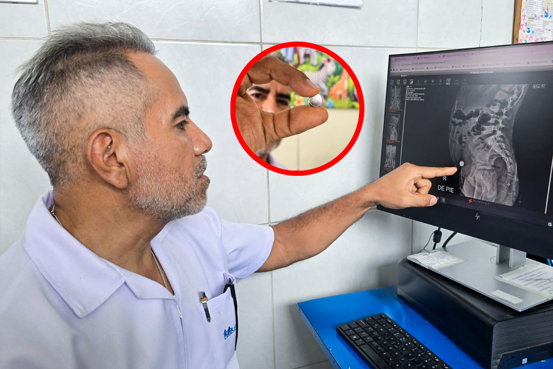 Se detect� una anomal�a intestinal en paralelo a la ubicaci�n de la pila alojada