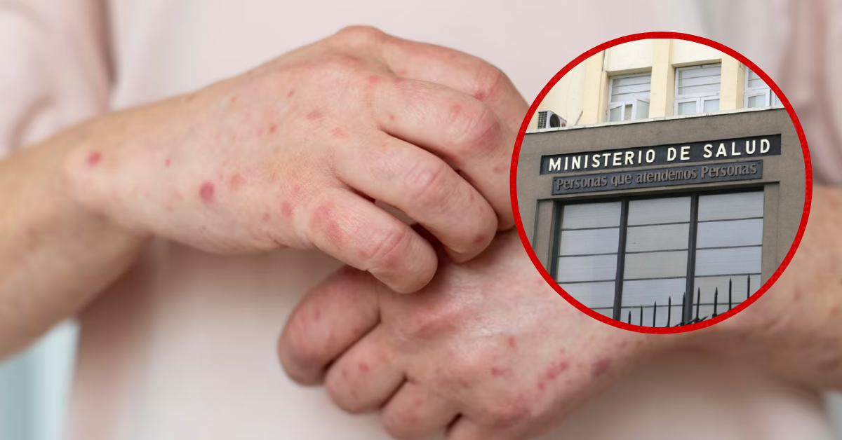 Minsa emite alerta epidemiológica por sarampión: Segundo caso fue confirmado en Lima