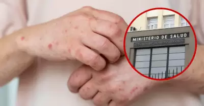 Minsa activa alerta epidemiol�gica ante casos de sarampi�n