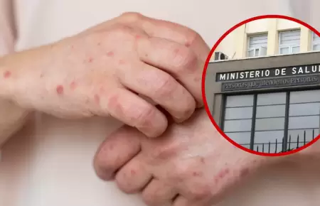 Minsa activa alerta epidemiol�gica ante casos de sarampi�n