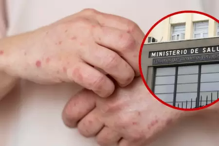 Minsa activa alerta epidemiol�gica ante casos de sarampi�n