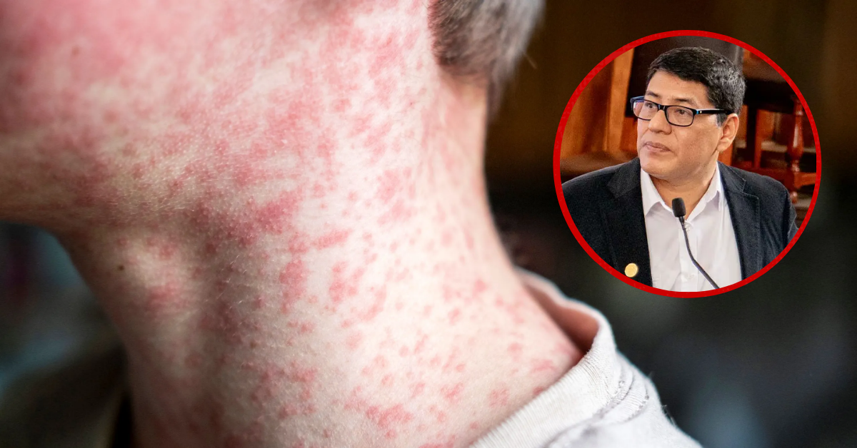 Más de 150 mil peruanos, entre niños y adultos, con riesgo de contagio por sarampión, indica Minsa