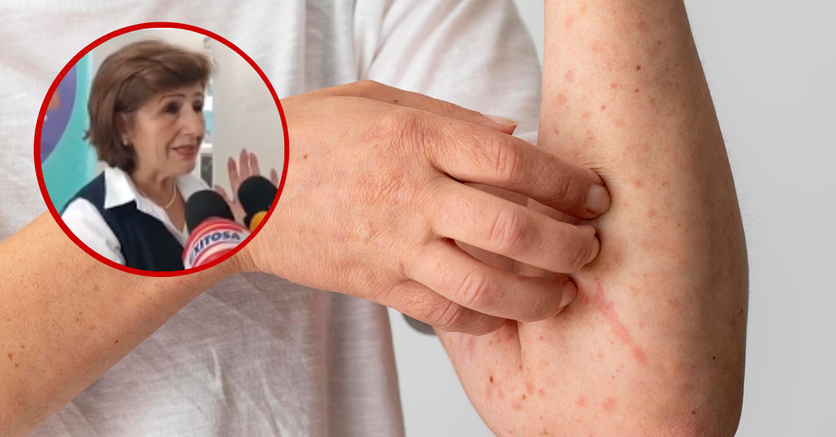 Cuatro casos sospechosos de sarampión en Arequipa: Dos serían adultos