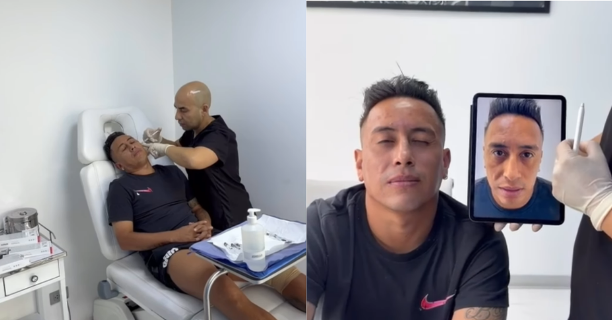 Christian Cueva se somete a nuevo 'retoquito' para mejorar su rostro: 