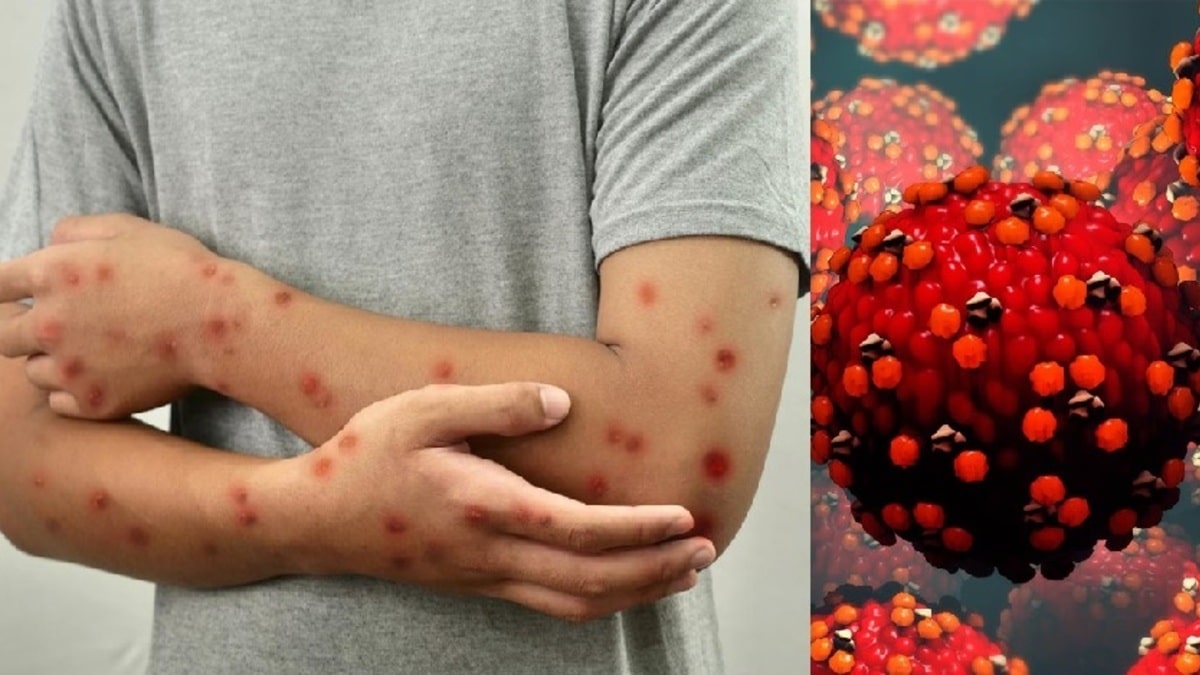 Control tiene como finalidad parar avance del sarampi�n