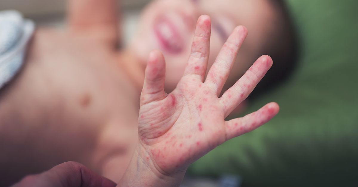 ¡Atención! UGEL Chiclayo dispone medidas preventivas en colegios por infección viral 