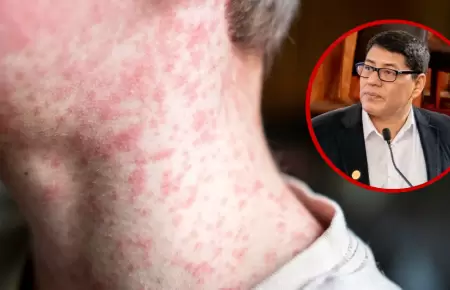 Sarampi�n puede afectar a ni�os y adultos peruanos