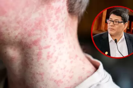 Sarampi�n puede afectar a ni�os y adultos peruanos