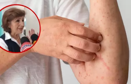 Cuatro posible casos de sarampi�n en Arequipa