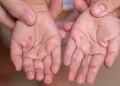 �Alerta sanitaria! Se reportan m�s de 30 casos de infecci�n viral "mano, pie y boca" en Lambayeque