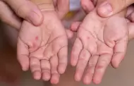 �Alerta sanitaria! Se reportan m�s de 30 casos de infecci�n viral "mano, pie y boca" en Lambayeque
