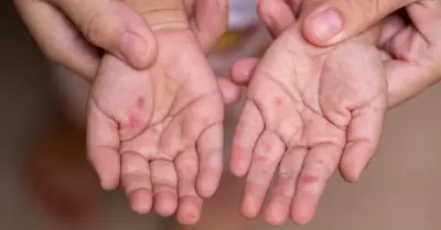 Infecci�n viral "mano, pie y boca"