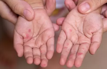 Infecci�n viral "mano, pie y boca"