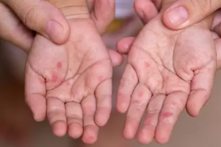 Infecci�n viral "mano, pie y boca"